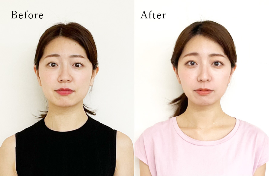 お顔の矯正BeforeAfter