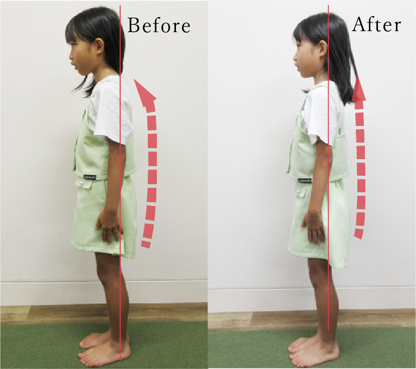 お子様の姿勢矯正BeforeAfter横