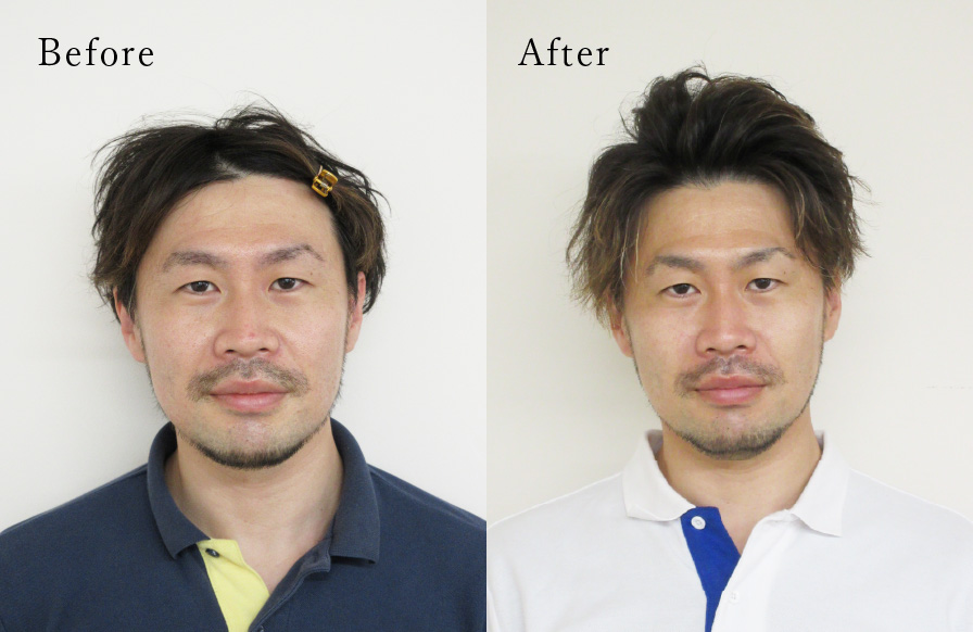 お顔の矯正BeforeAfterの写真